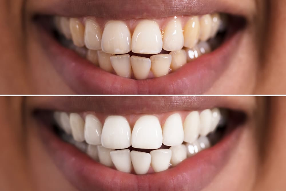 before and after teeth whitening Dr. Darren Dotson D.D.S. Dr. Amy Hartzell D.D.S. Hill Avenue Dental. General, Cosmetic, Restorative, Preventative, Family Dentistry Dentist in Spirit Lake, IA 51360