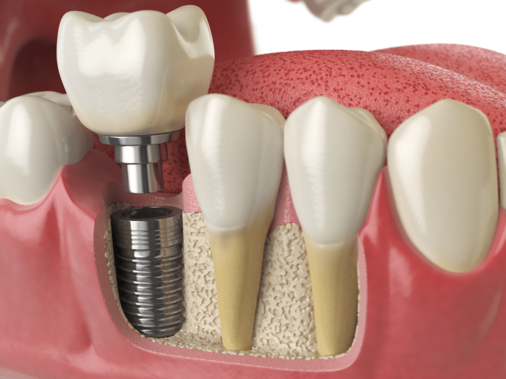 Dental Implants in Spirit Lake, Iowa Dr. Darren Dotson D.D.S. Dr. Amy Hartzell D.D.S. Hill Avenue Dental. General, Cosmetic, Restorative, Preventative, Family Dentistry Dentist in Spirit Lake, IA 51360