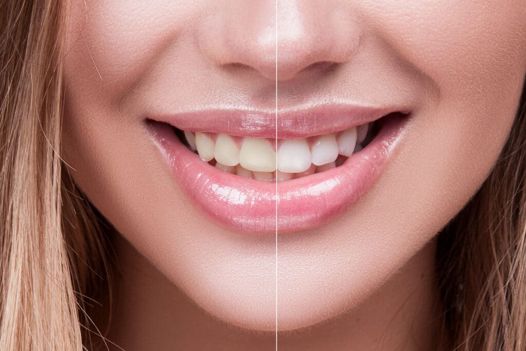 teeth whitening spirit lake before and after teeth whitening