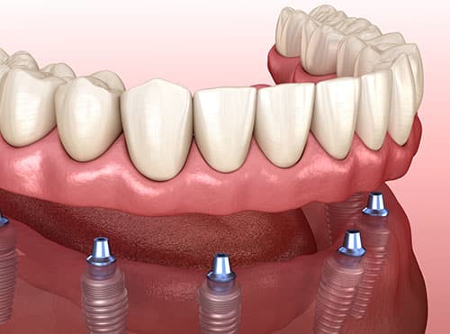 implant supported dentures