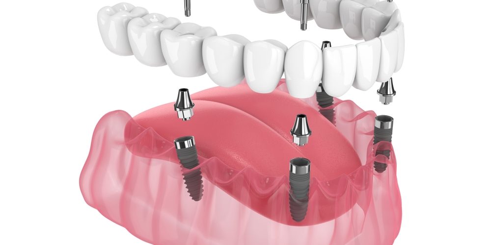 all-on-4 implants near me Dr. Darren Dotson D.D.S. Dr. Amy Hartzell D.D.S. Hill Avenue Dental. General, Cosmetic, Restorative, Preventative, Family Dentistry Dentist in Spirit Lake, IA 51360