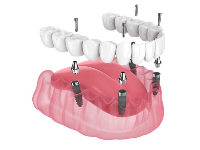 all-on-4 implants near me Dr. Darren Dotson D.D.S. Dr. Amy Hartzell D.D.S. Hill Avenue Dental. General, Cosmetic, Restorative, Preventative, Family Dentistry Dentist in Spirit Lake, IA 51360 all-on-4 implants near me Dr. Darren Dotson D.D.S. Dr. Amy Hartzell D.D.S. Hill Avenue Dental. General, Cosmetic, Restorative, Preventative, Family Dentistry Dentist in Spirit Lake, IA 51360