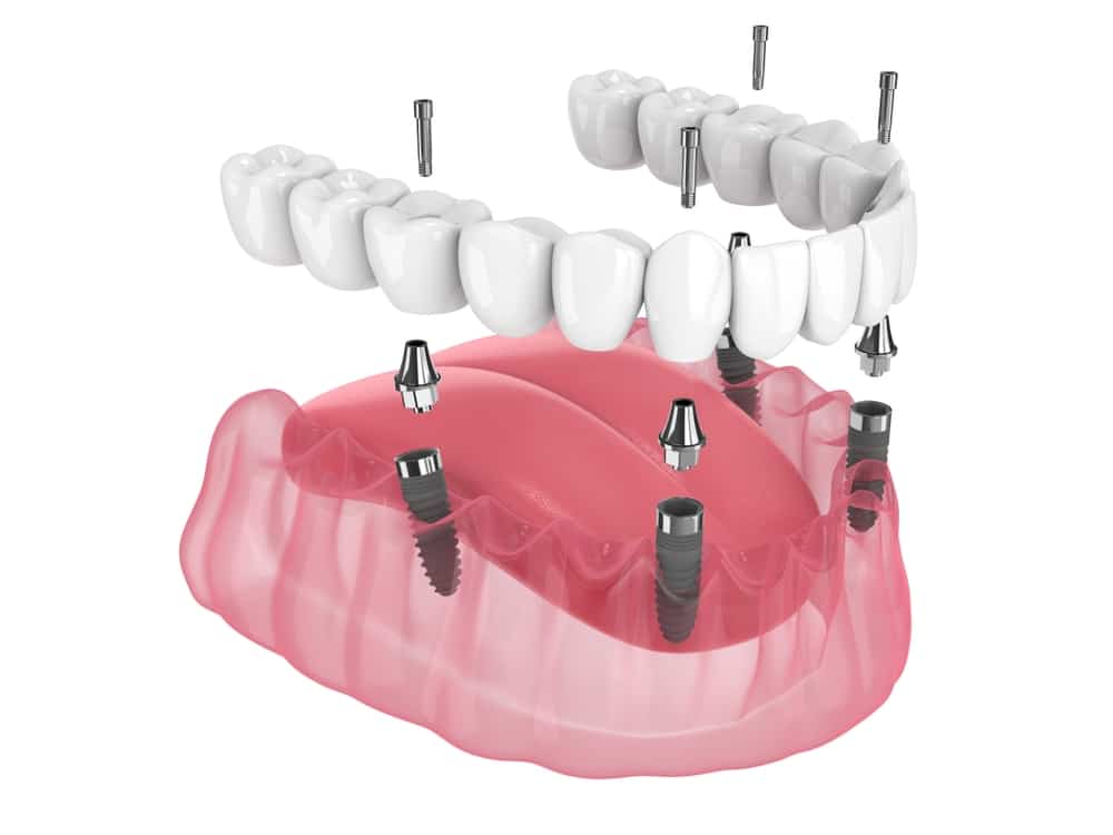 all-on-4 implants near me Dr. Darren Dotson D.D.S. Dr. Amy Hartzell D.D.S. Hill Avenue Dental. General, Cosmetic, Restorative, Preventative, Family Dentistry Dentist in Spirit Lake, IA 51360