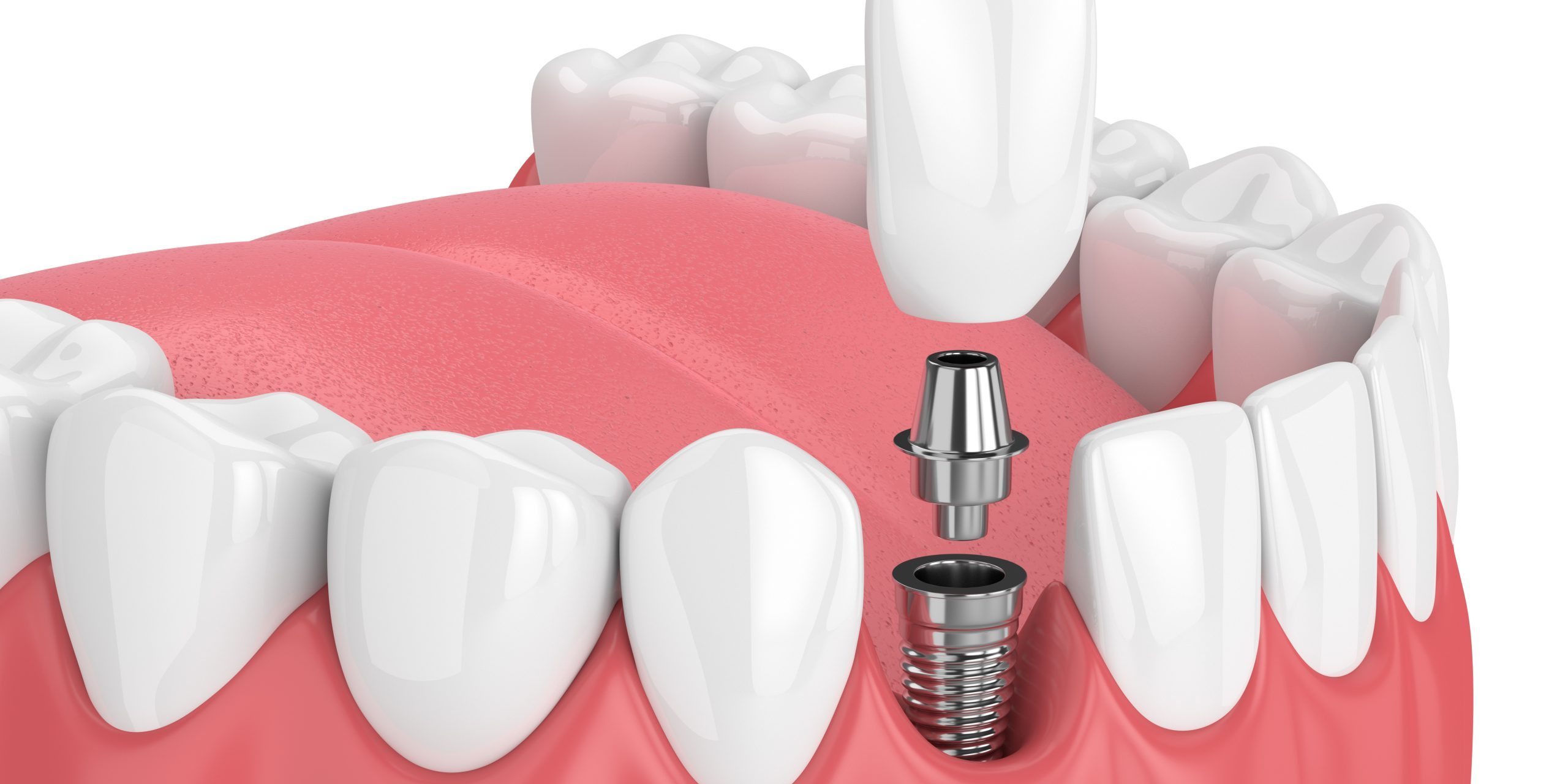 dental implants spirit lake Hill Avenue Dental dentist in Spirit Lake, IA Dr. Darren Dotson D.D.S. Dr. Amy Hartzell