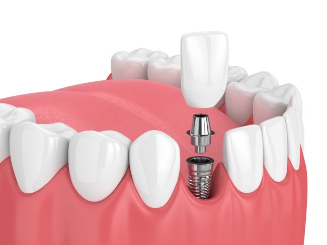 dental implants spirit lake Hill Avenue Dental dentist in Spirit Lake, IA Dr. Darren Dotson D.D.S. Dr. Amy Hartzell dental implants spirit lake Hill Avenue Dental dentist in Spirit Lake, IA Dr. Darren Dotson D.D.S. Dr. Amy Hartzell
