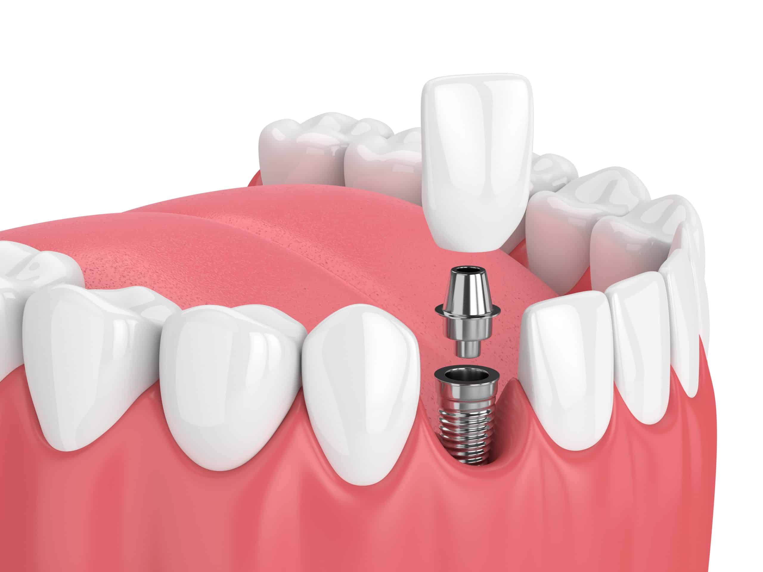 dental implants spirit lake Hill Avenue Dental dentist in Spirit Lake, IA Dr. Darren Dotson D.D.S. Dr. Amy Hartzell