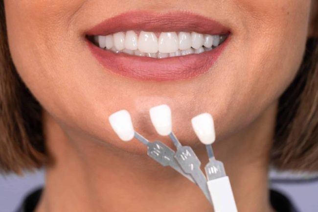 Whitening,Concept.,Dental,Care,,Implants,For,Veneers.,Beautiful,Caucasian,Woman veneers spirit lake