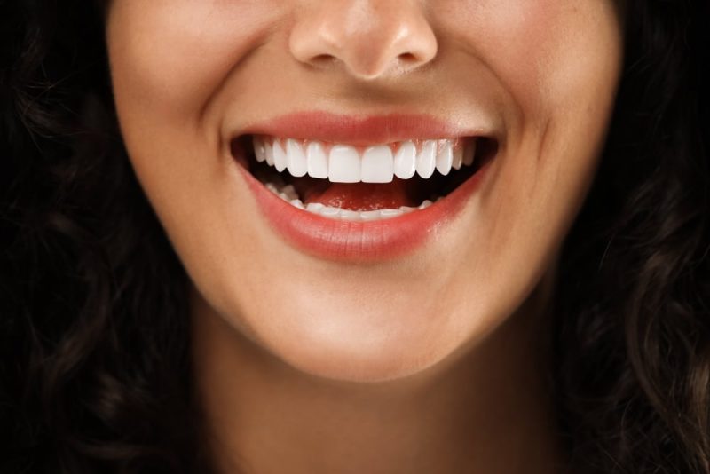 Closeup,View,Of,Smiling,Woman.,Dental,Veneers dental crowns spirit lake