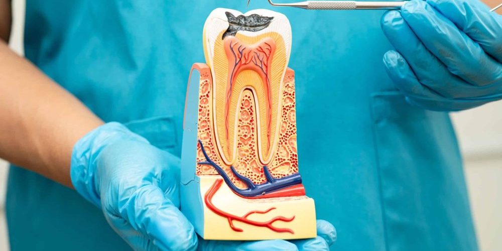 root canal therapy spirit lake