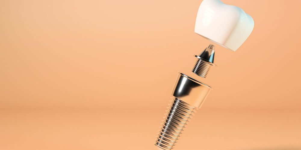 all-on-4 implants near me